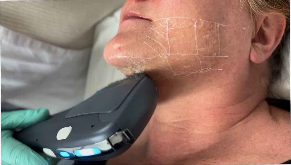 HIFU neck fat removal vs traditional methods