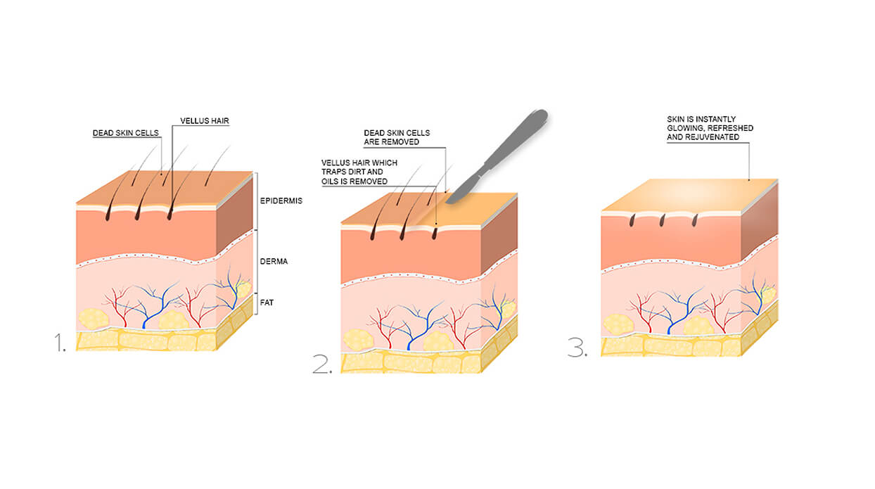 How it works dermapiling What is Dermaplaning and how does it work?