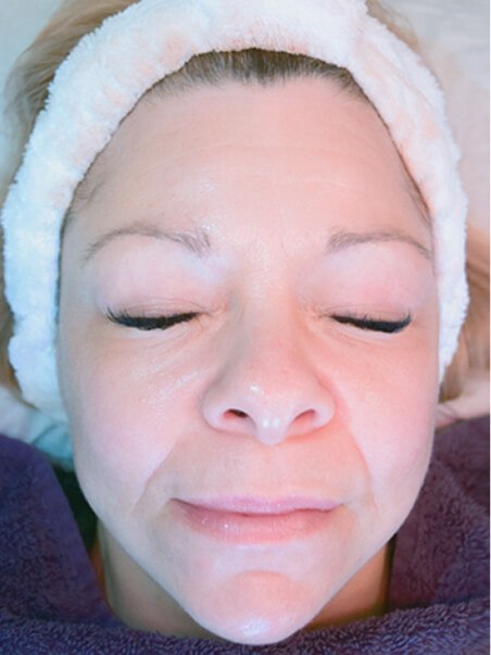 HydroJet Aquafacial treatment in action
 after result