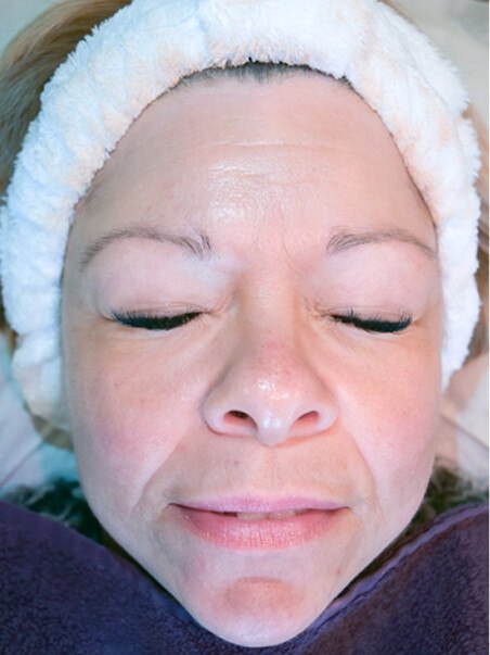 HydroJet Aquafacial treatment in action
 before result