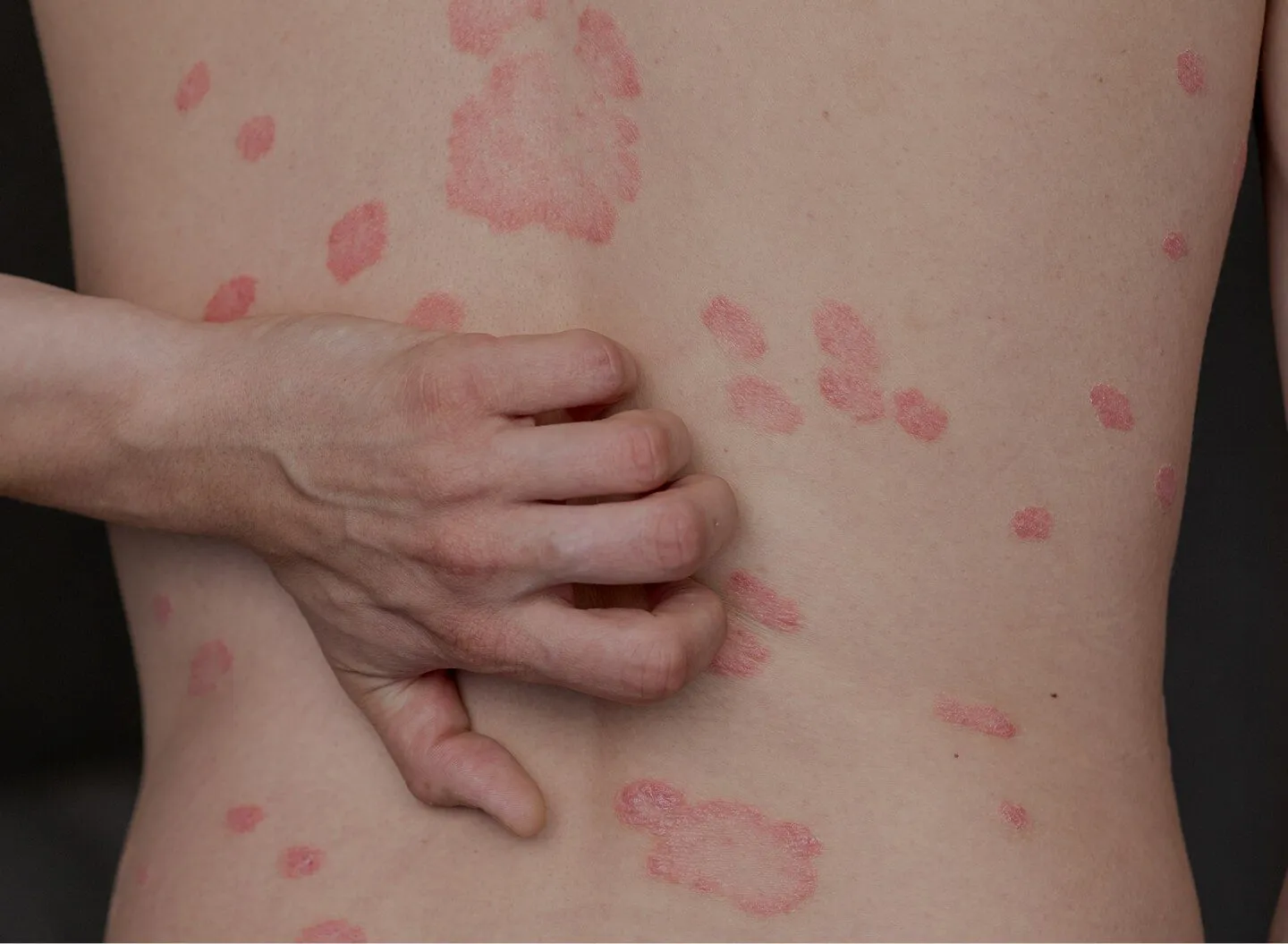 Psoriasis