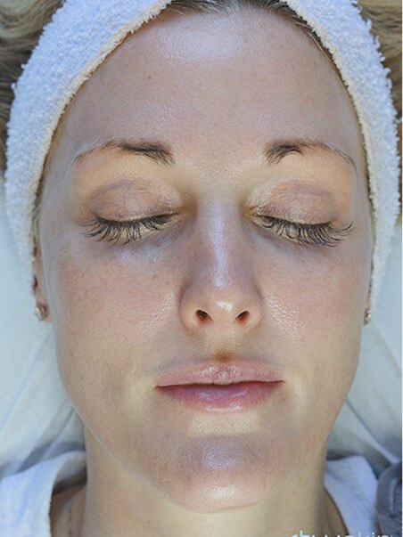 HydroJet Aquafacial treatment in action
 after result