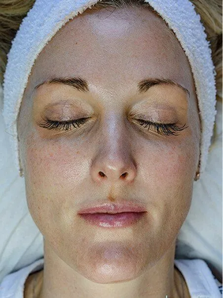 HydroJet Aquafacial treatment in action
 before result