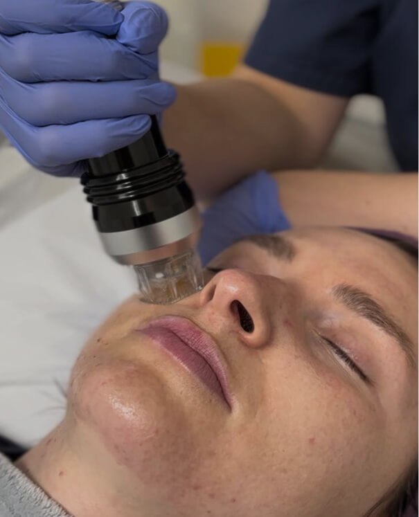 RF Microneedling & Dermapen Dermaroller