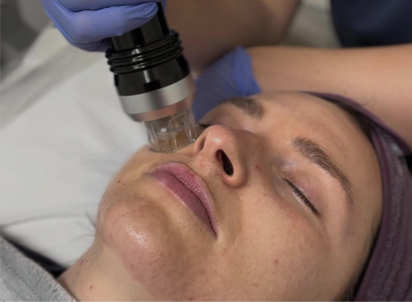 RF Microneedling & Dermaroller