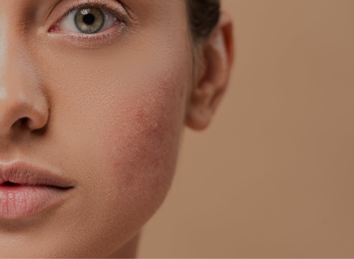 Rosacea