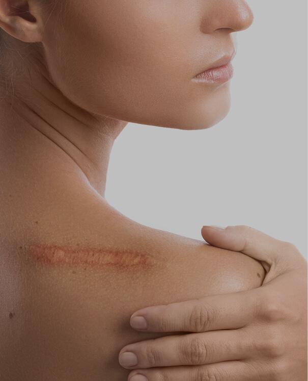 Scar Revision