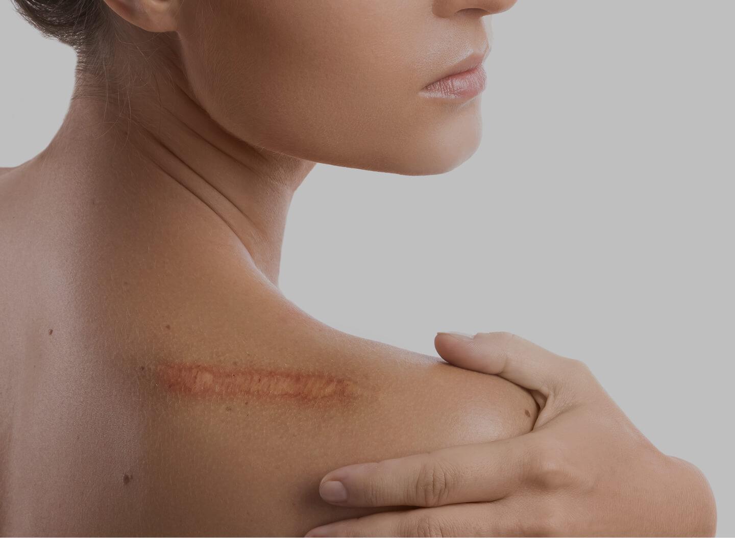 Scar Revision Scar Revision - rtwskin clinic