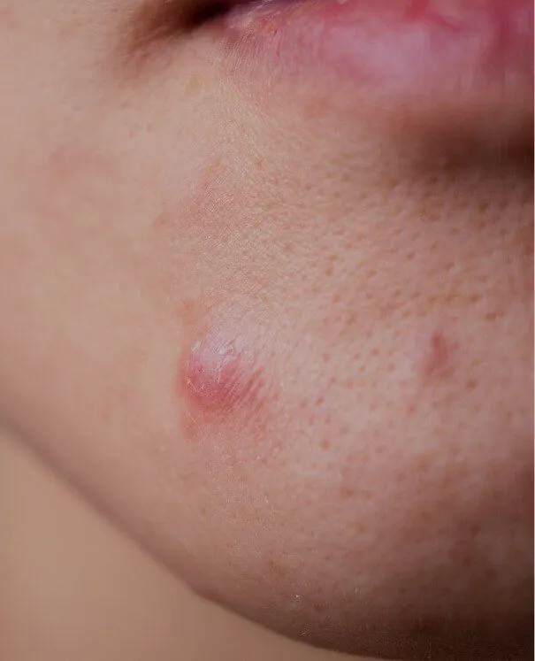 Spot Injections small Сortisone injection for pimple - rtwskin clinic