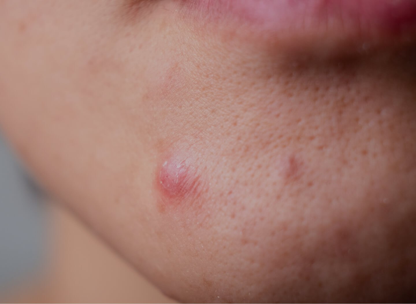 Spot Injections