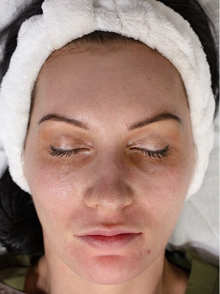 Chemical Peels treatment in action
 after result