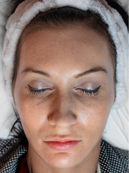 Chemical Peels treatment in action
 before result