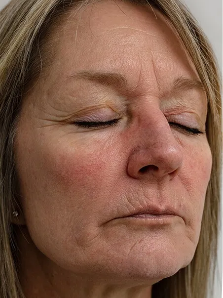 Rosacea treatment in action
 before result