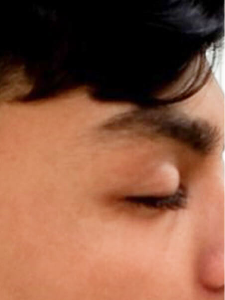 Vitiligo treatment in action
 after result