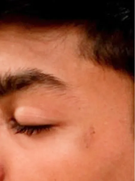 Vitiligo treatment in action
 after result