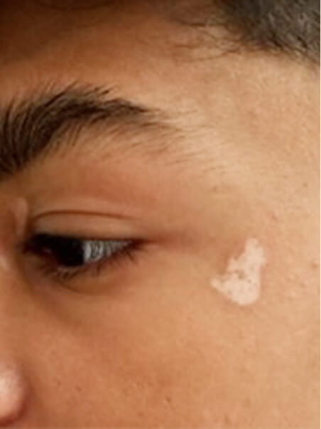 Vitiligo treatment in action
 before result