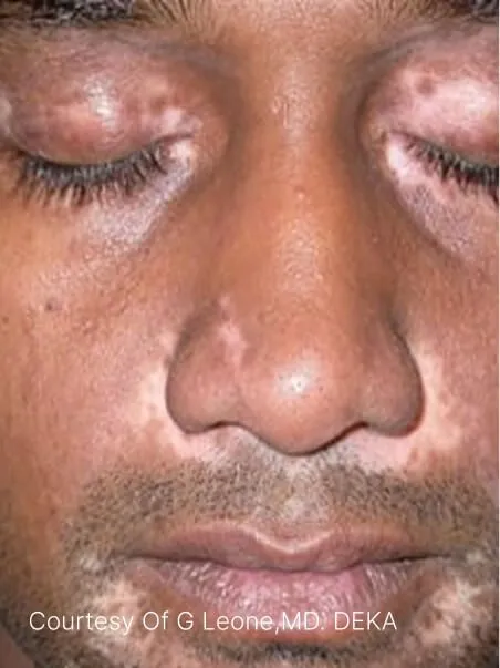 Vitiligo treatment in action
 before result