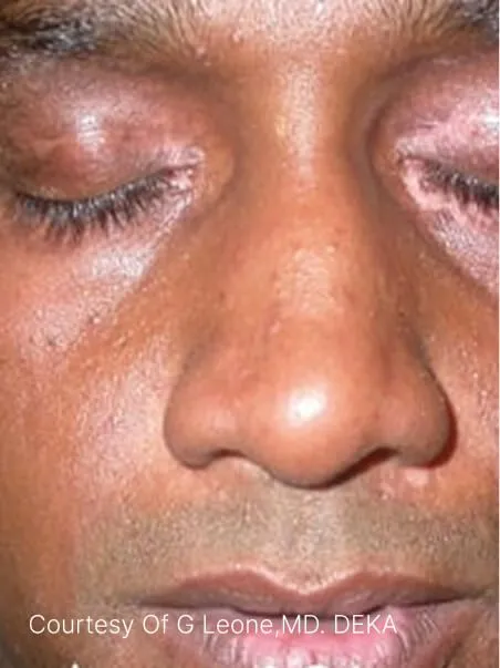 Vitiligo treatment in action
 after result