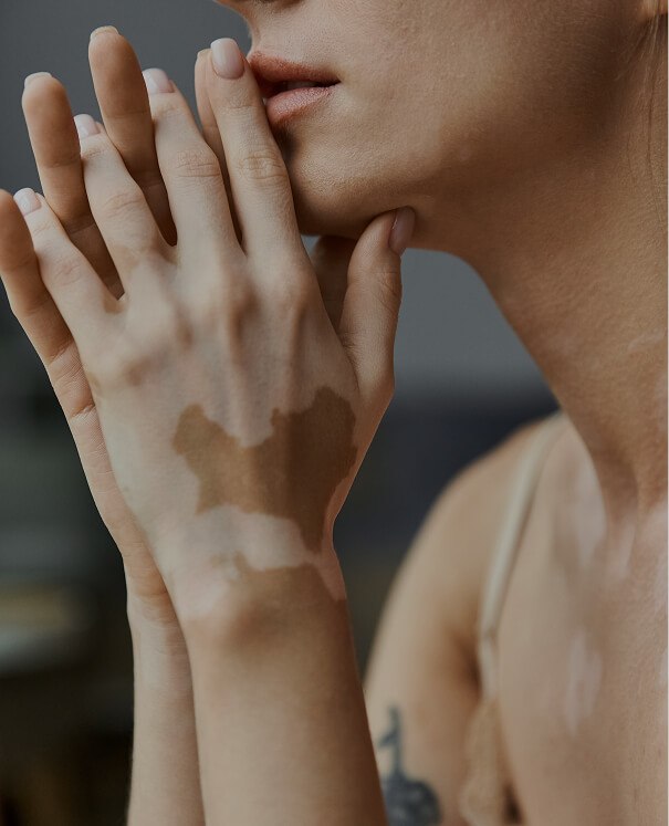 Vitiligo