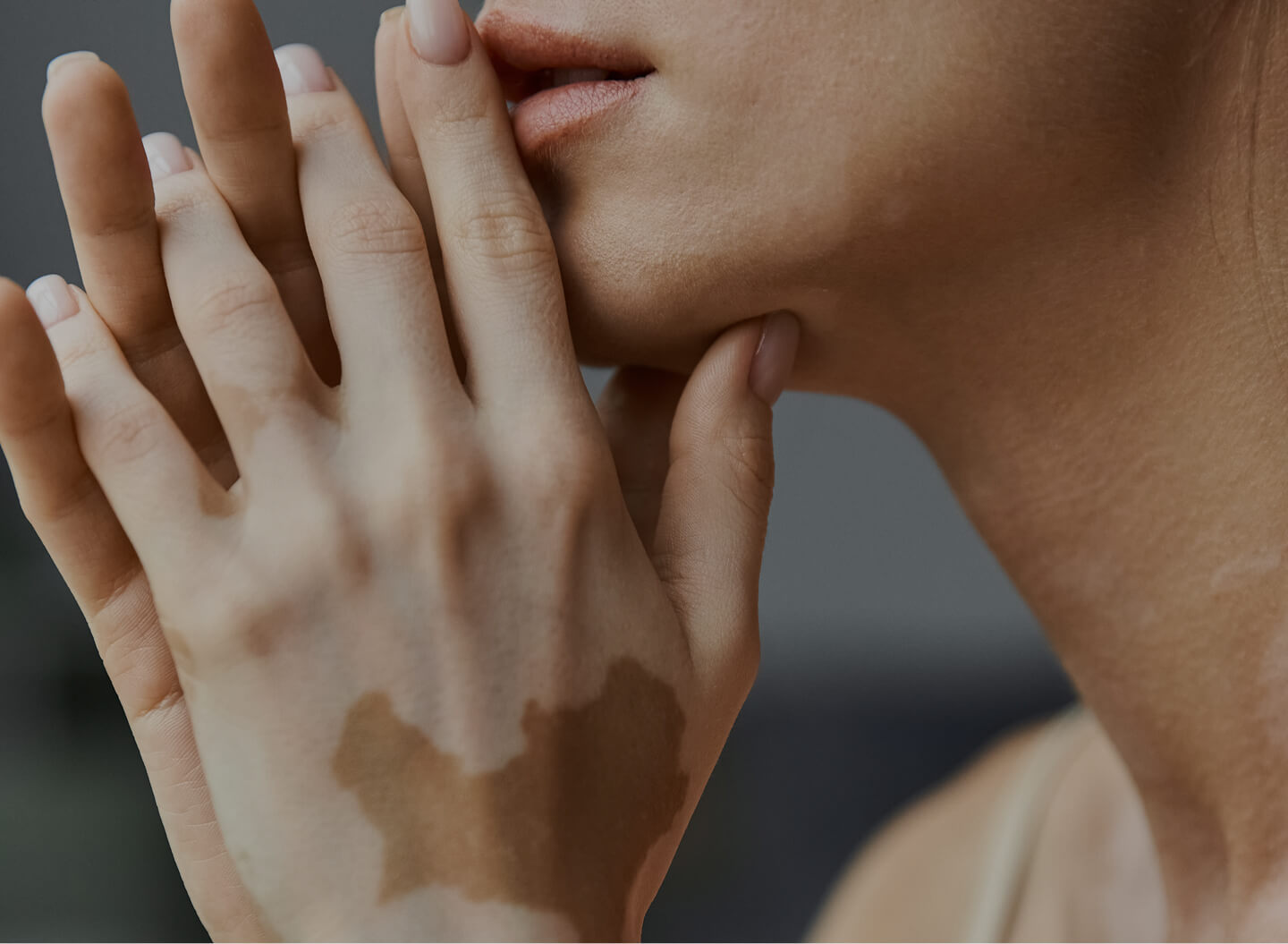 Vitiligo