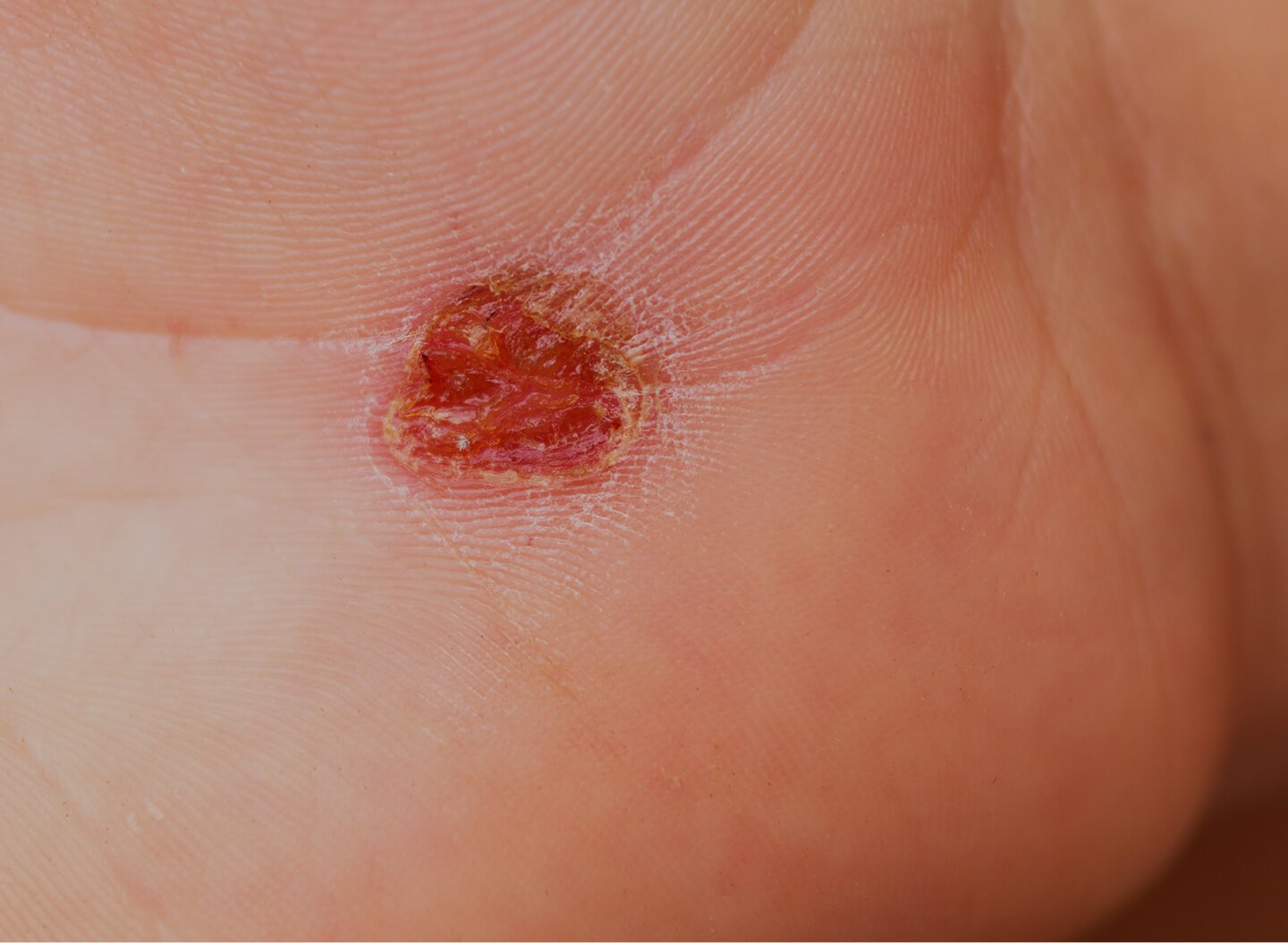 Wart and Verucca