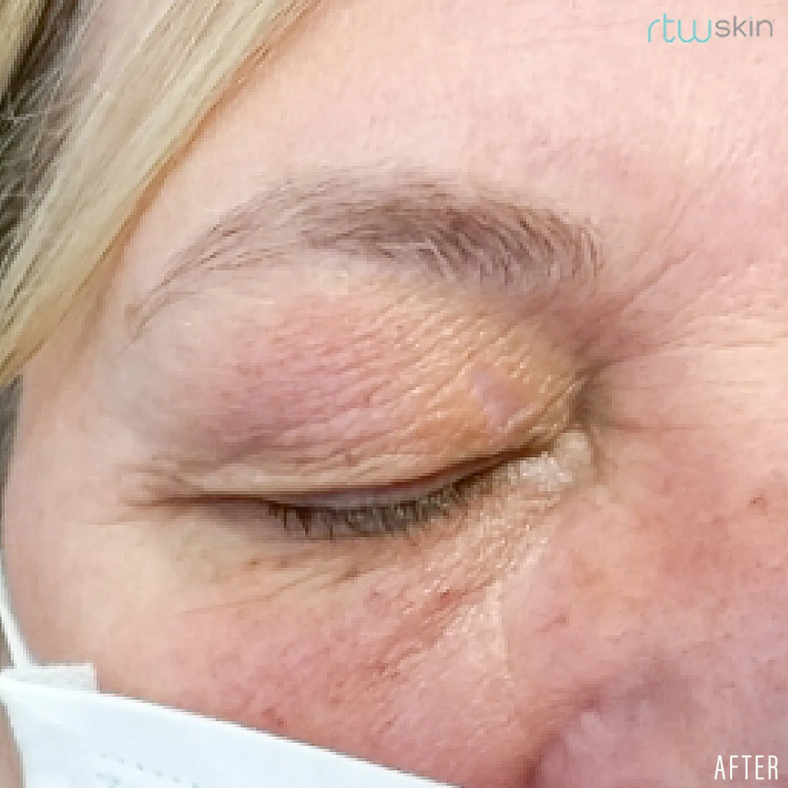 Xanthelasma treatment in action
 after result