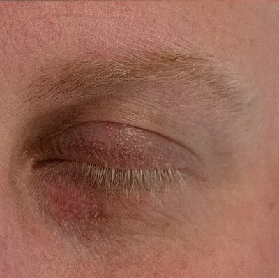 Xanthelasma treatment in action
 after result