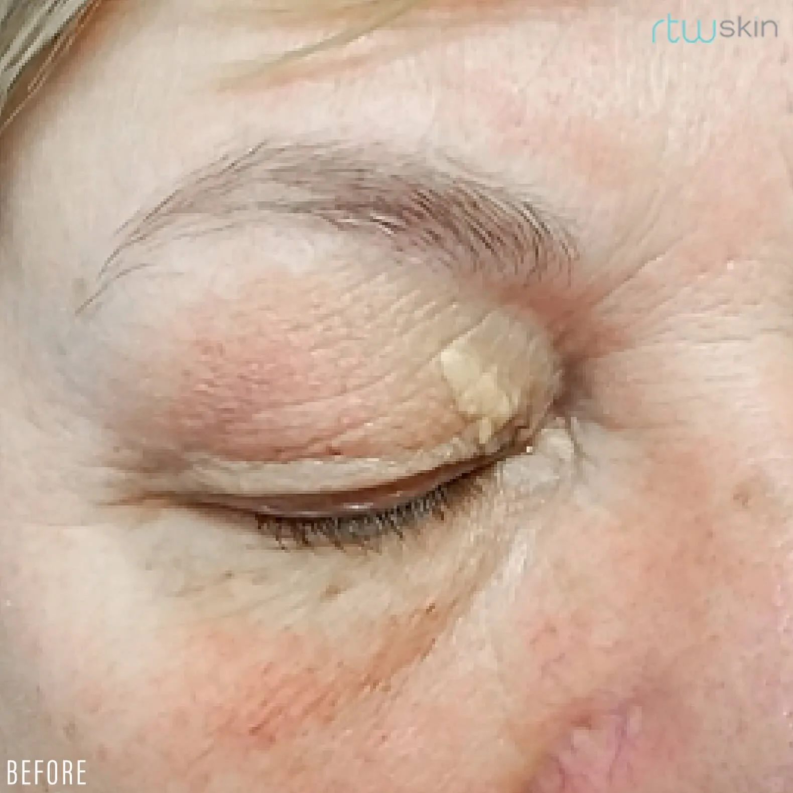 Xanthelasma treatment in action
 before result