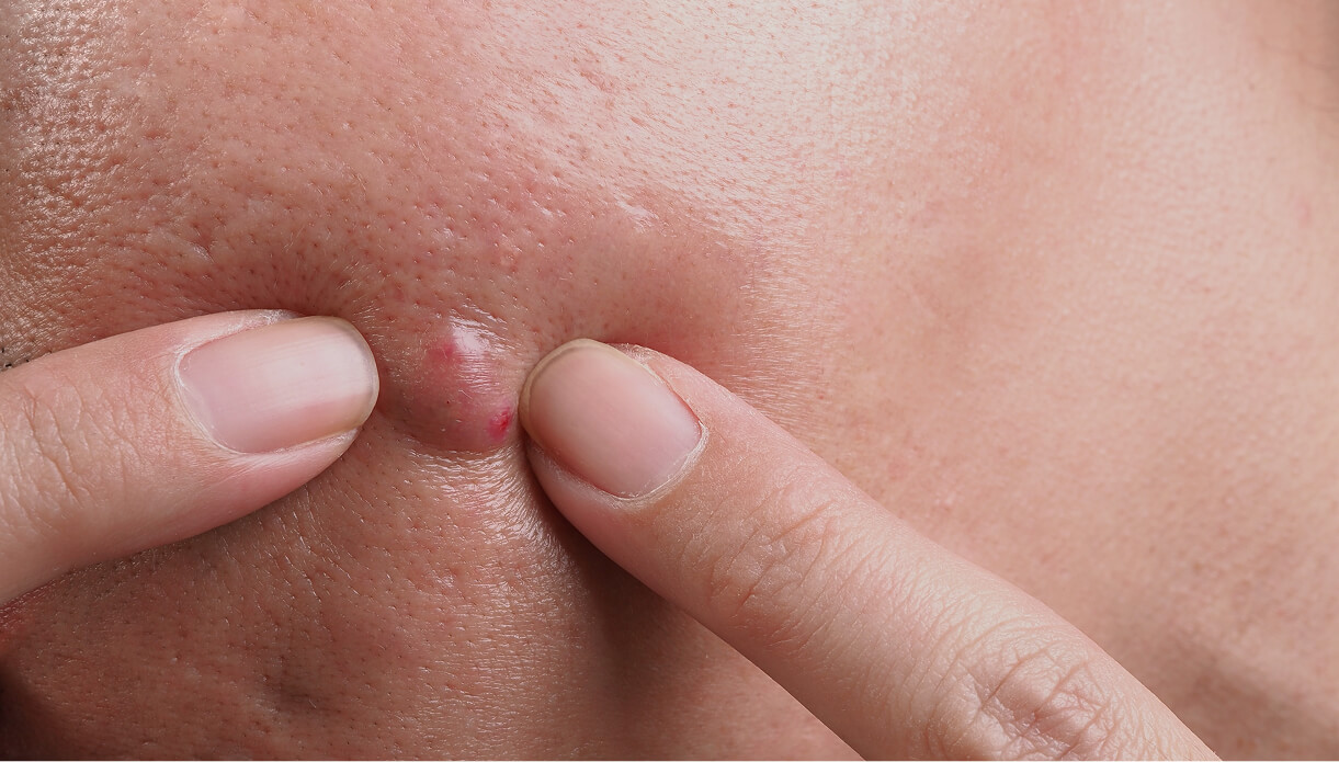 Сortisone injection for pimple How it Works How it Works