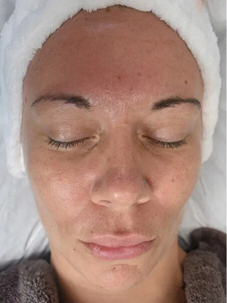 Chemical Peels in action before results