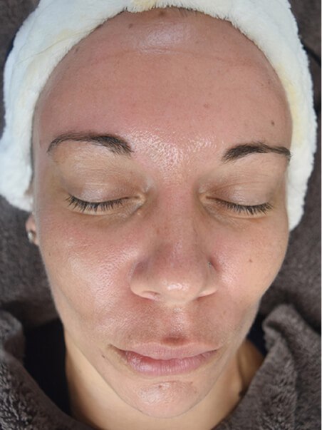 HydroJet Aquafacial treatment in action
 after result