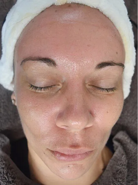 Chemical Peels in action after results