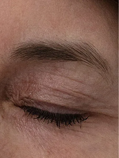 The Madonna Eye Lift treatment in action
 after result