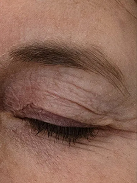 The Madonna Eye Lift treatment in action
 before result