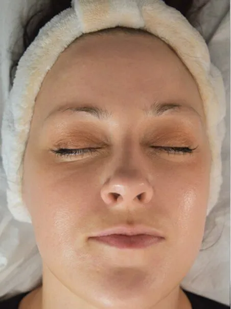 Dermaplaning treatment in action
 after result