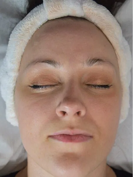 Dermaplaning treatment in action
 before result