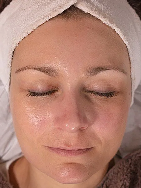 Chemical Peels in action after results