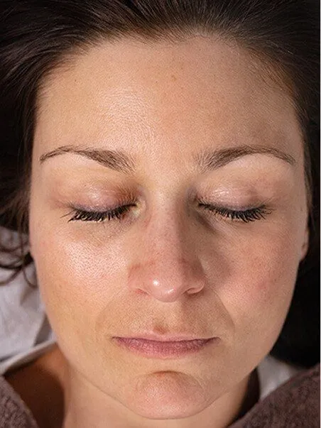 Chemical Peels in action before results