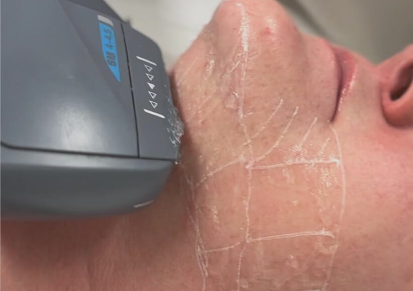 HIFU treatment What makes HIFU stand out from other skin tightening procedures?