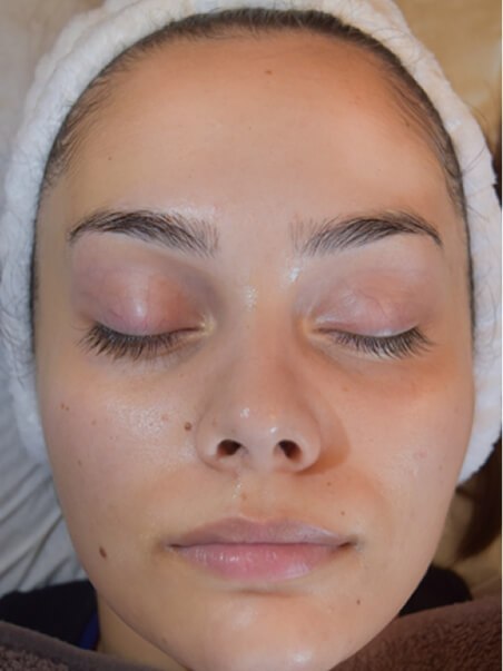 HydroJet Aquafacial treatment in action
 after result