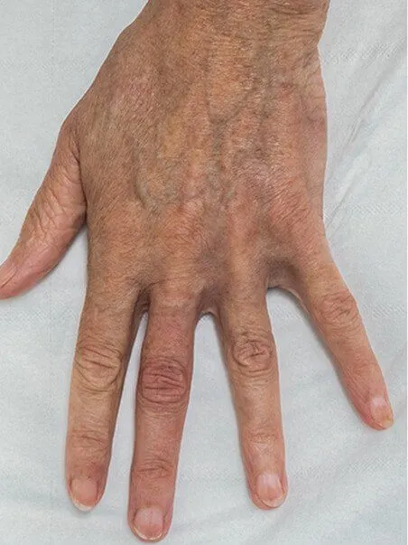 Pigmentation treatment  in action after results