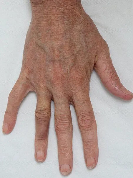 Pigmentation treatment  in action after results