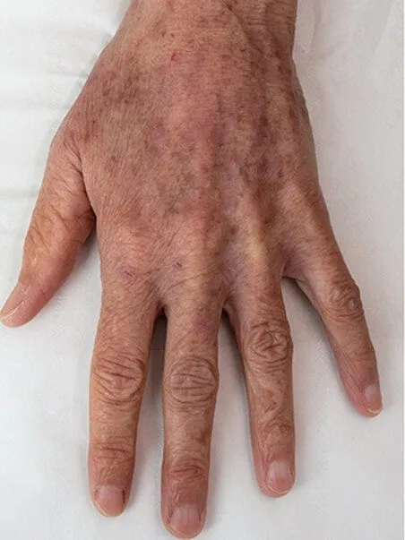 Pigmentation treatment  in action before results