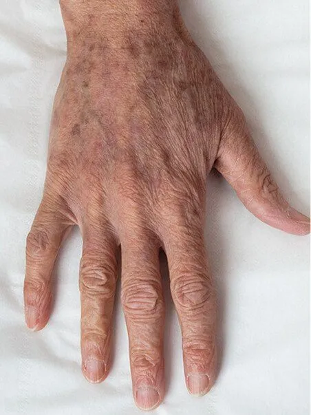 Pigmentation treatment  in action before results