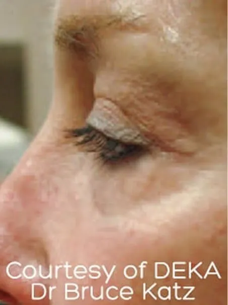 The Madonna Eye Lift treatment in action
 after result