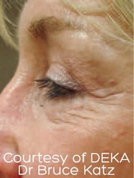 Dermal fillers in action before results