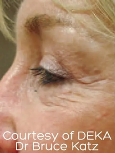 The Madonna Eye Lift treatment in action
 before result