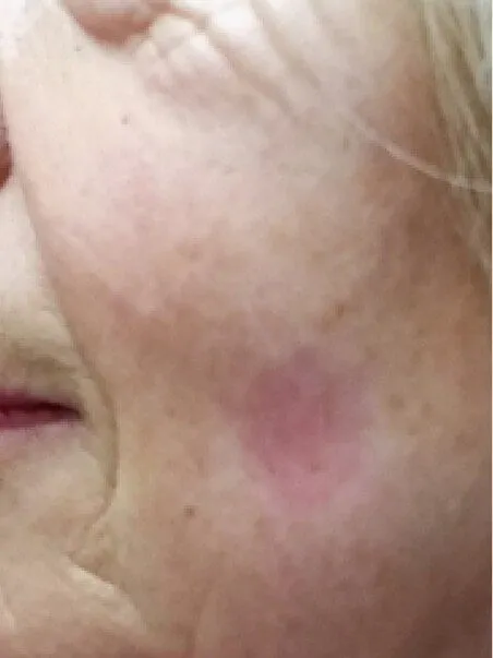 Pigmentation treatment  in action after results