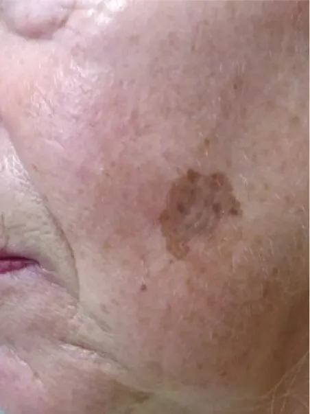 Pigmentation treatment  in action before results