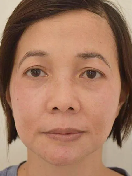 Pigmentation treatment  in action after results
